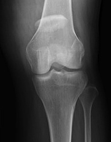 Patella Fracture Displaced AP